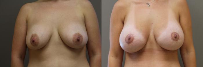 Breast Lift with Implants (Traditional & Donut) Case 23 Before & After View #1 | Webster, TX | Houston Plastic and Reconstructive Surgery