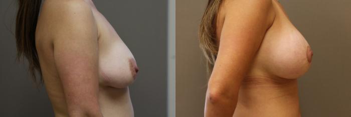 Breast Lift with Implants (Traditional & Donut) Case 23 Before & After View #2 | Webster, TX | Houston Plastic and Reconstructive Surgery