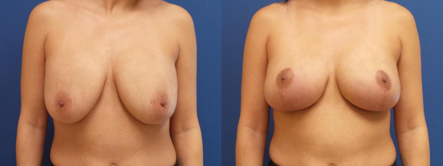 Breast Lift with Implants (Traditional & Donut) Case 266 Before & After View #1 | Webster, TX | Houston Plastic and Reconstructive Surgery