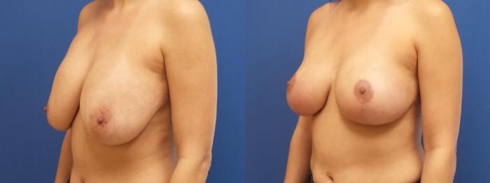 Breast Lift with Implants (Traditional & Donut) Case 266 Before & After View #2 | Webster, TX | Houston Plastic and Reconstructive Surgery