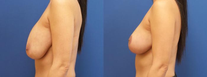 Breast Lift with Implants (Traditional & Donut) Case 266 Before & After View #3 | Webster, TX | Houston Plastic and Reconstructive Surgery