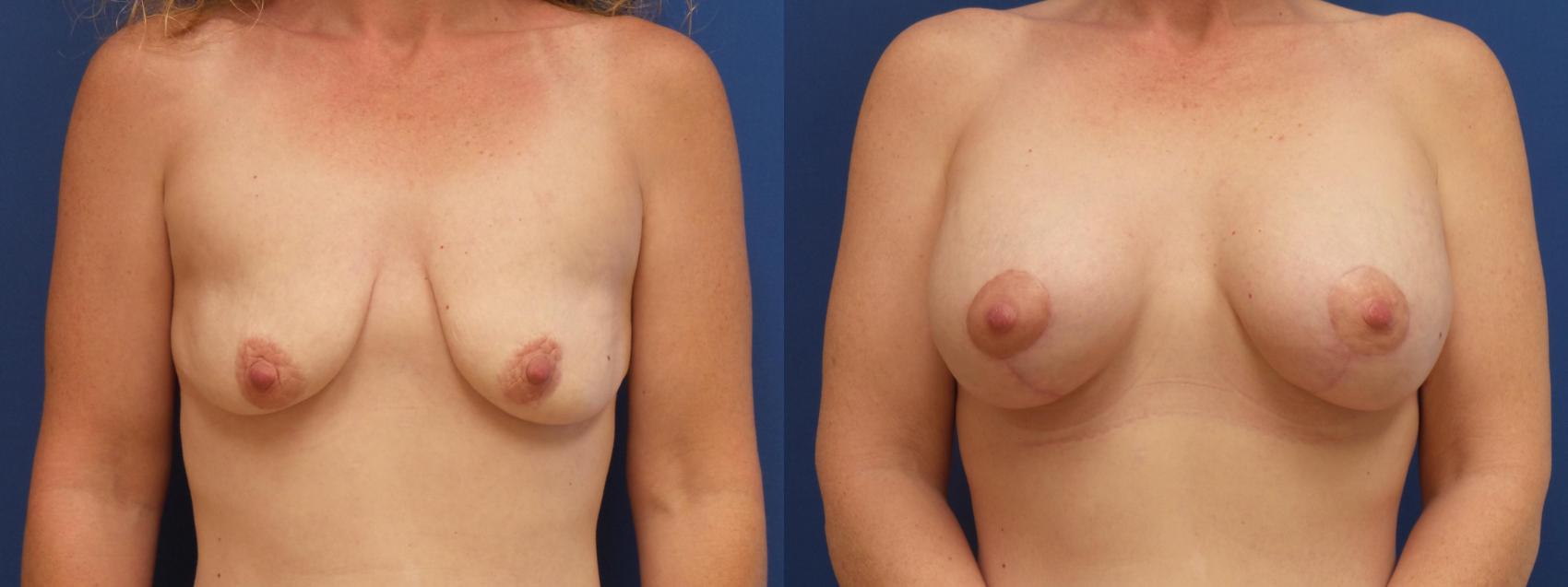 Breast Lift with Implants (Traditional & Donut) Case 270 Before & After View #1 | Webster, TX | Houston Plastic and Reconstructive Surgery