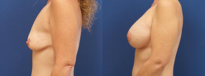 Breast Lift with Implants (Traditional & Donut) Case 270 Before & After View #2 | Webster, TX | Houston Plastic and Reconstructive Surgery