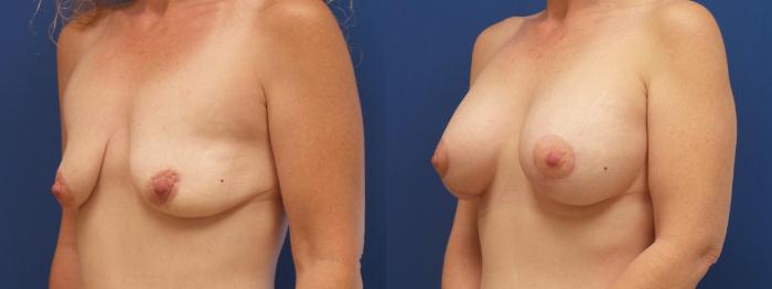 Breast Lift with Implants (Traditional & Donut) Case 270 Before & After View #3 | Webster, TX | Houston Plastic and Reconstructive Surgery