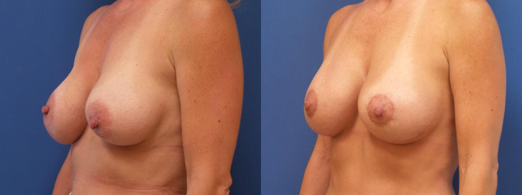 Breast Lift with Implants (Traditional & Donut) Case 279 Before & After View #1 | Webster, TX | Houston Plastic and Reconstructive Surgery