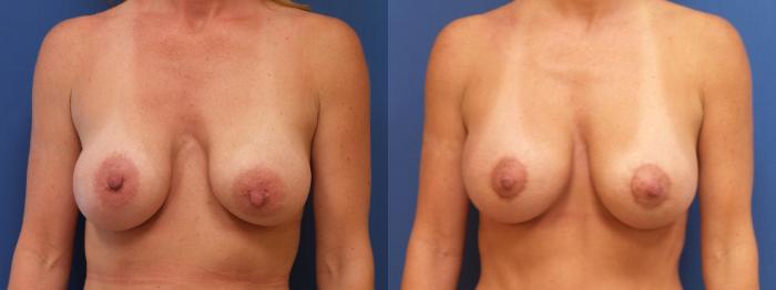 Breast Lift with Implants (Traditional & Donut) Case 279 Before & After View #2 | Webster, TX | Houston Plastic and Reconstructive Surgery