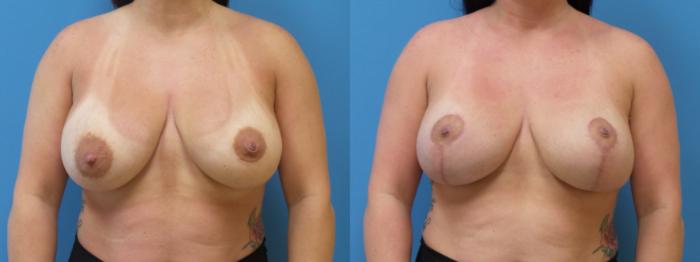 Breast Lift with Implants (Traditional & Donut) Case 288 Before & After Front | Webster, TX | Houston Plastic and Reconstructive Surgery