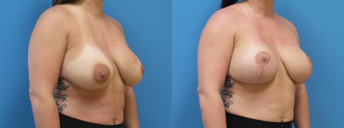 Breast Implant Exchange Case 288 Before & After Right Oblique | Webster, TX | Houston Plastic and Reconstructive Surgery