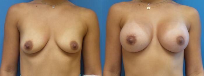Breast Lift with Implants (Traditional & Donut) Case 290 Before & After Front | Webster, TX | Houston Plastic and Reconstructive Surgery
