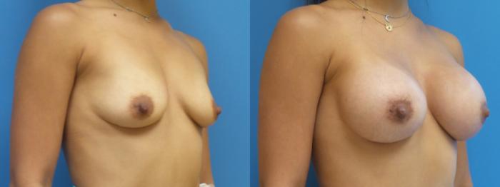 Breast Lift with Implants (Traditional & Donut) Case 290 Before & After Right Oblique | Webster, TX | Houston Plastic and Reconstructive Surgery