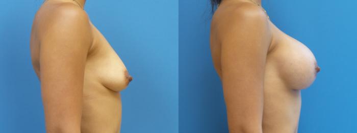 Breast Lift with Implants (Traditional & Donut) Case 290 Before & After Right Side | Webster, TX | Houston Plastic and Reconstructive Surgery