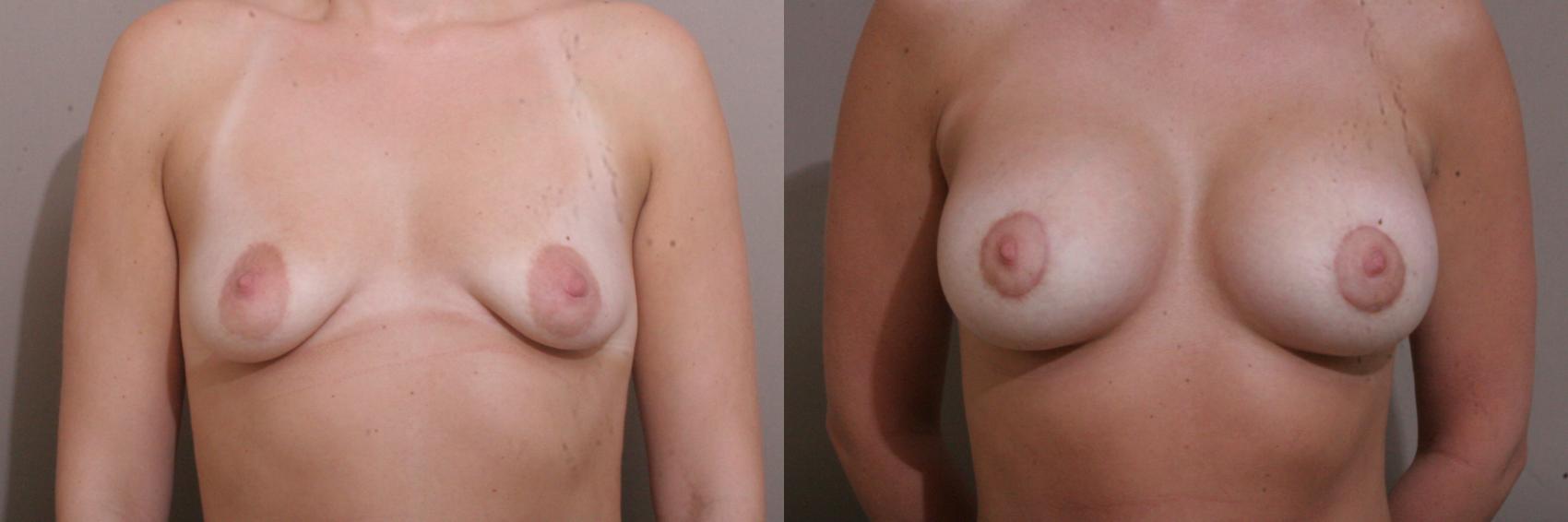 Breast Lift with Implants (Traditional & Donut) Case 52 Before & After View #1 | Webster, TX | Houston Plastic and Reconstructive Surgery