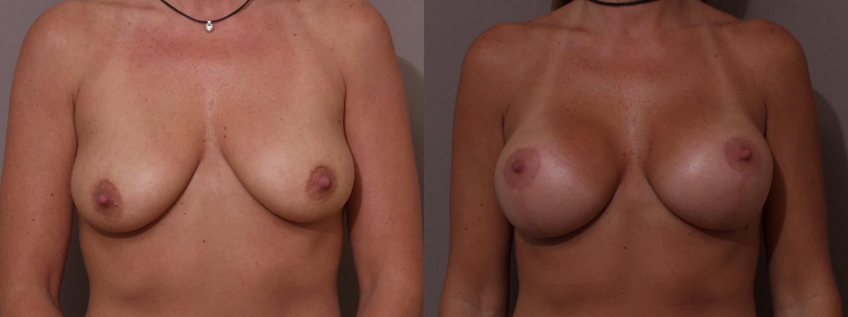 Breast Lift with Implants (Traditional & Donut) Case 79 Before & After View #1 | Webster, TX | Houston Plastic and Reconstructive Surgery