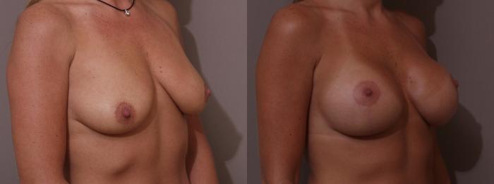 Breast Lift with Implants (Traditional & Donut) Case 79 Before & After View #2 | Webster, TX | Houston Plastic and Reconstructive Surgery