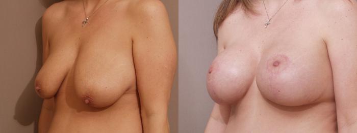 Breast Lift with Implants (Traditional & Donut) Case 86 Before & After View #2 | Webster, TX | Houston Plastic and Reconstructive Surgery