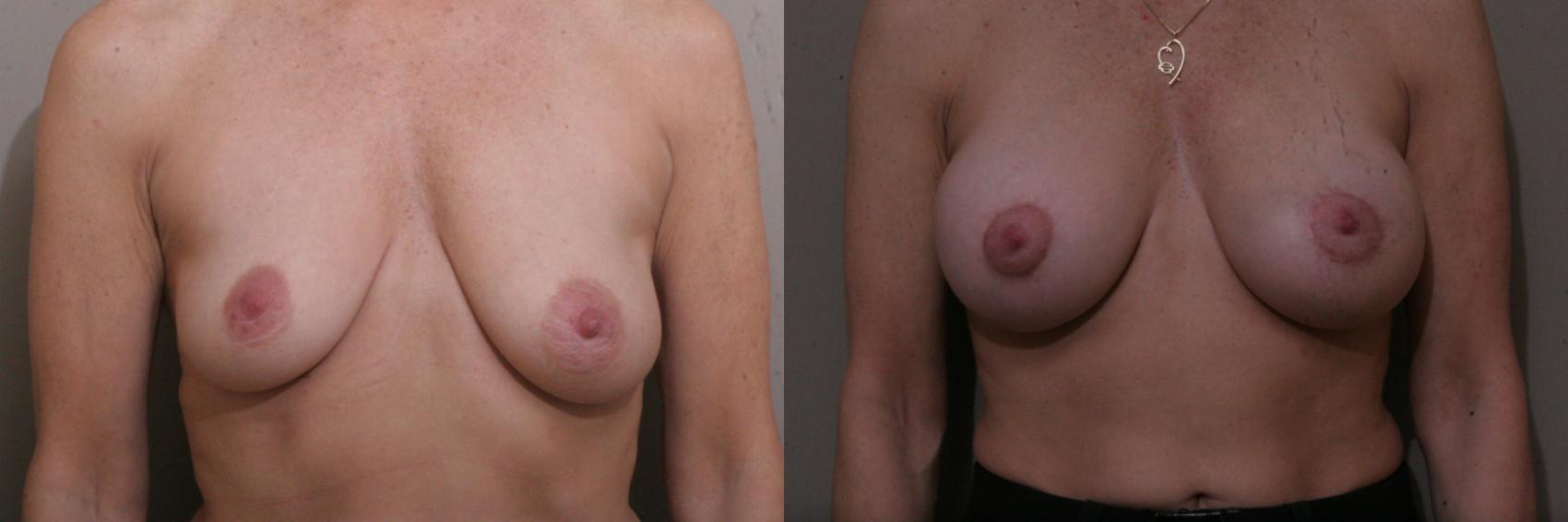 Breast Lift with Implants (Traditional & Donut) Case 90 Before & After View #1 | Webster, TX | Houston Plastic and Reconstructive Surgery