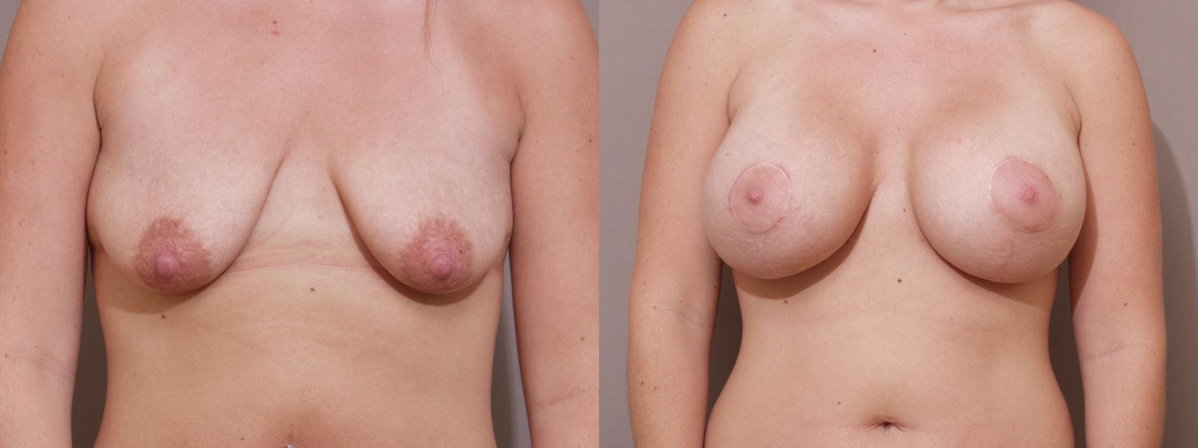 Breast Lift with Implants (Traditional & Donut) Case 94 Before & After View #1 | Webster, TX | Houston Plastic and Reconstructive Surgery