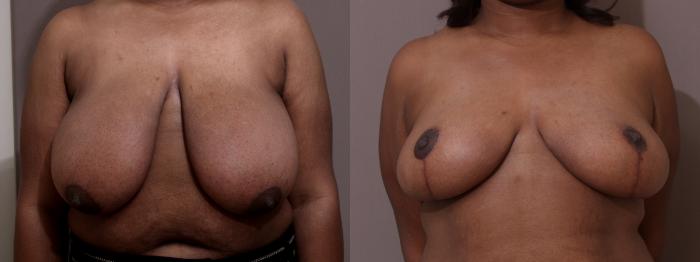 Breast Reduction Case 122 Before & After View #1 | Webster, TX | Houston Plastic and Reconstructive Surgery
