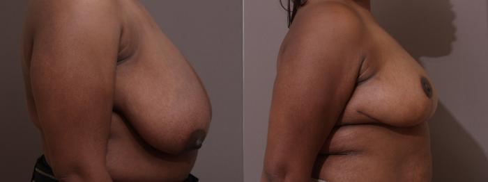 Breast Reduction Case 122 Before & After View #2 | Webster, TX | Houston Plastic and Reconstructive Surgery