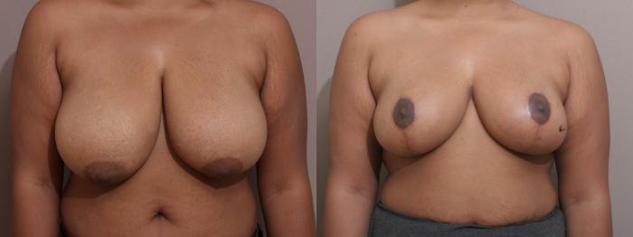 Breast Reduction Case 159 Before & After View #1 | Webster, TX | Houston Plastic and Reconstructive Surgery