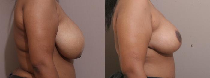 Breast Reduction Case 159 Before & After View #2 | Webster, TX | Houston Plastic and Reconstructive Surgery