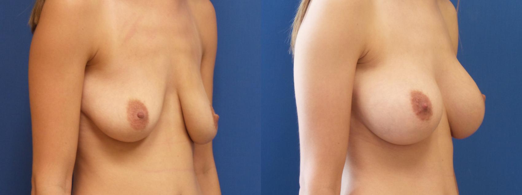 Breast Reduction Case 224 Before & After View #1 | Webster, TX | Houston Plastic and Reconstructive Surgery