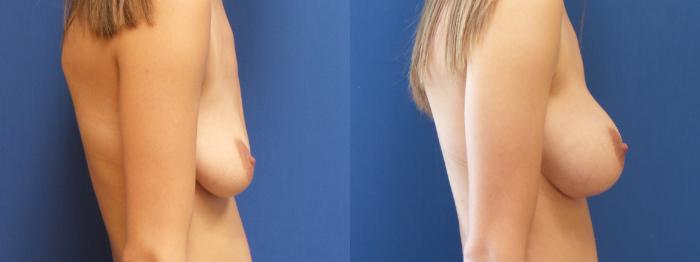 Breast Reduction Case 224 Before & After View #2 | Webster, TX | Houston Plastic and Reconstructive Surgery