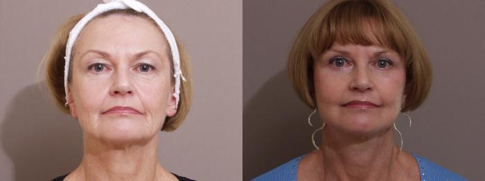 Facelift Case 11 Before & After View #1 | Webster, TX | Houston Plastic and Reconstructive Surgery