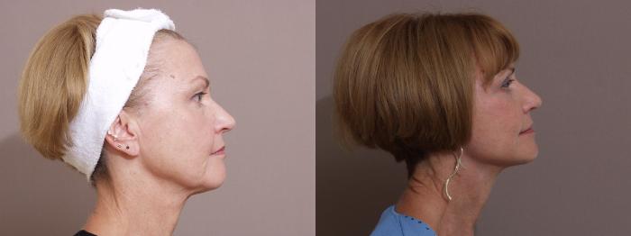 Facelift Case 11 Before & After View #2 | Webster, TX | Houston Plastic and Reconstructive Surgery