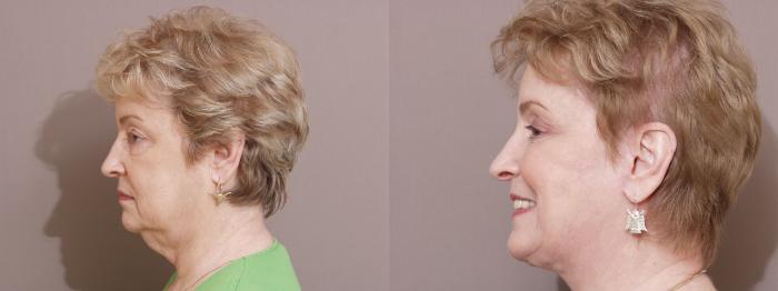 Facelift Case 114 Before & After View #2 | Webster, TX | Houston Plastic and Reconstructive Surgery