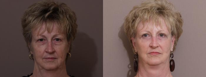 Facelift Case 242 Before & After View #1 | Webster, TX | Houston Plastic and Reconstructive Surgery