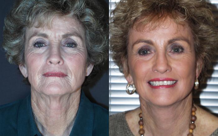 Facelift Case 245 Before & After View #1 | Webster, TX | Houston Plastic and Reconstructive Surgery