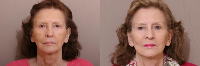 Facelift Case 246 Before & After View #1 | Webster, TX | Houston Plastic and Reconstructive Surgery