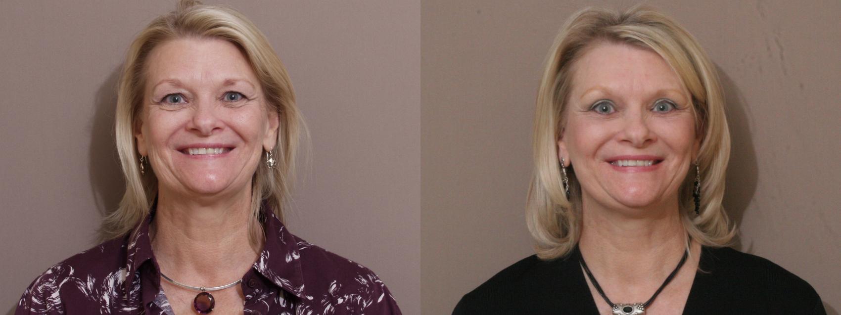 Facelift Case 247 Before & After View #1 | Webster, TX | Houston Plastic and Reconstructive Surgery