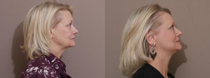 Facelift Case 247 Before & After View #2 | Webster, TX | Houston Plastic and Reconstructive Surgery