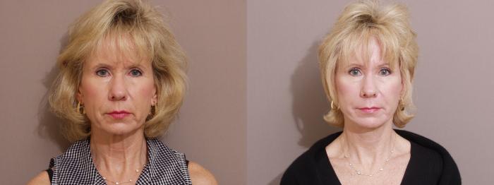 Facelift Case 248 Before & After View #1 | Webster, TX | Houston Plastic and Reconstructive Surgery