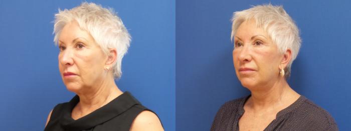 Facelift Case 253 Before & After View #1 | Webster, TX | Houston Plastic and Reconstructive Surgery
