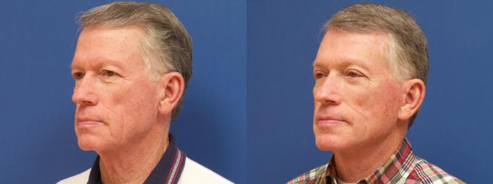 Facelift Case 264 Before & After View #1 | Webster, TX | Houston Plastic and Reconstructive Surgery