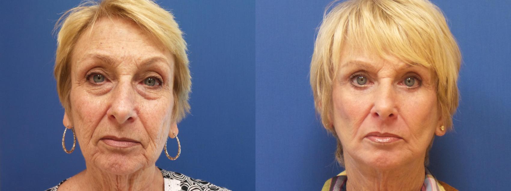 Facelift Case 280 Before & After View #1 | Webster, TX | Houston Plastic and Reconstructive Surgery