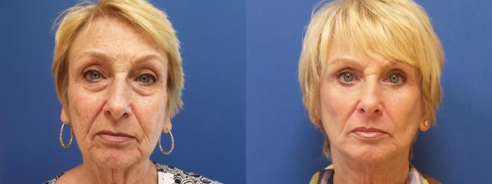 Facelift Case 280 Before & After View #1 | Webster, TX | Houston Plastic and Reconstructive Surgery