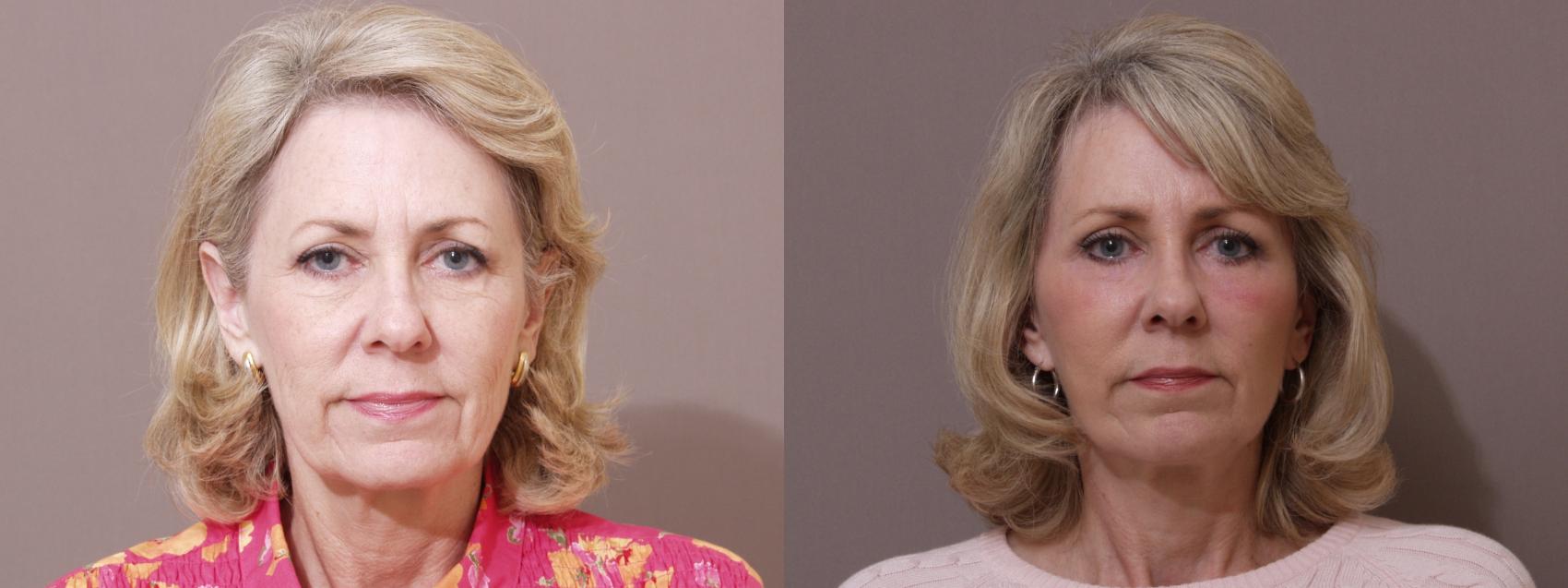 Facelift Case 38 Before & After View #1 | Webster, TX | Houston Plastic and Reconstructive Surgery