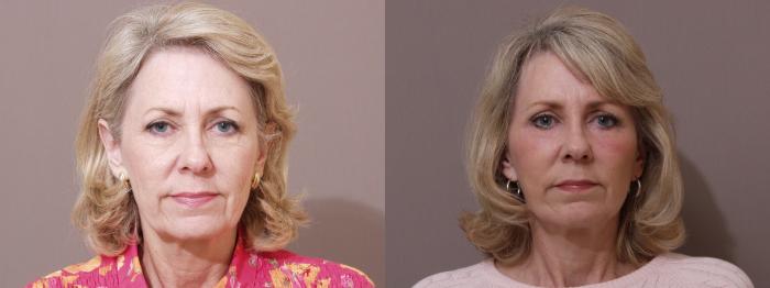 Facelift Case 38 Before & After View #1 | Webster, TX | Houston Plastic and Reconstructive Surgery