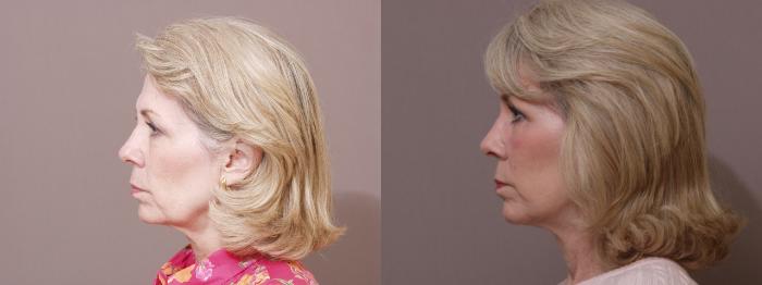 Facelift Case 38 Before & After View #2 | Webster, TX | Houston Plastic and Reconstructive Surgery