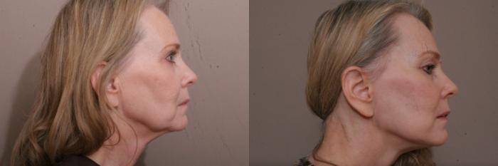 Facelift Case 72 Before & After View #2 | Webster, TX | Houston Plastic and Reconstructive Surgery