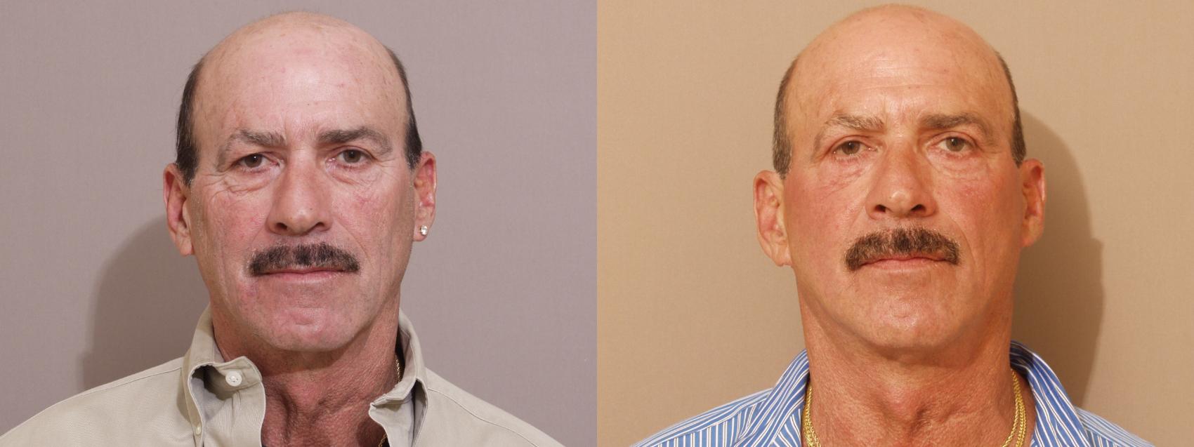 Facelift Case 81 Before & After View #1 | Webster, TX | Houston Plastic and Reconstructive Surgery