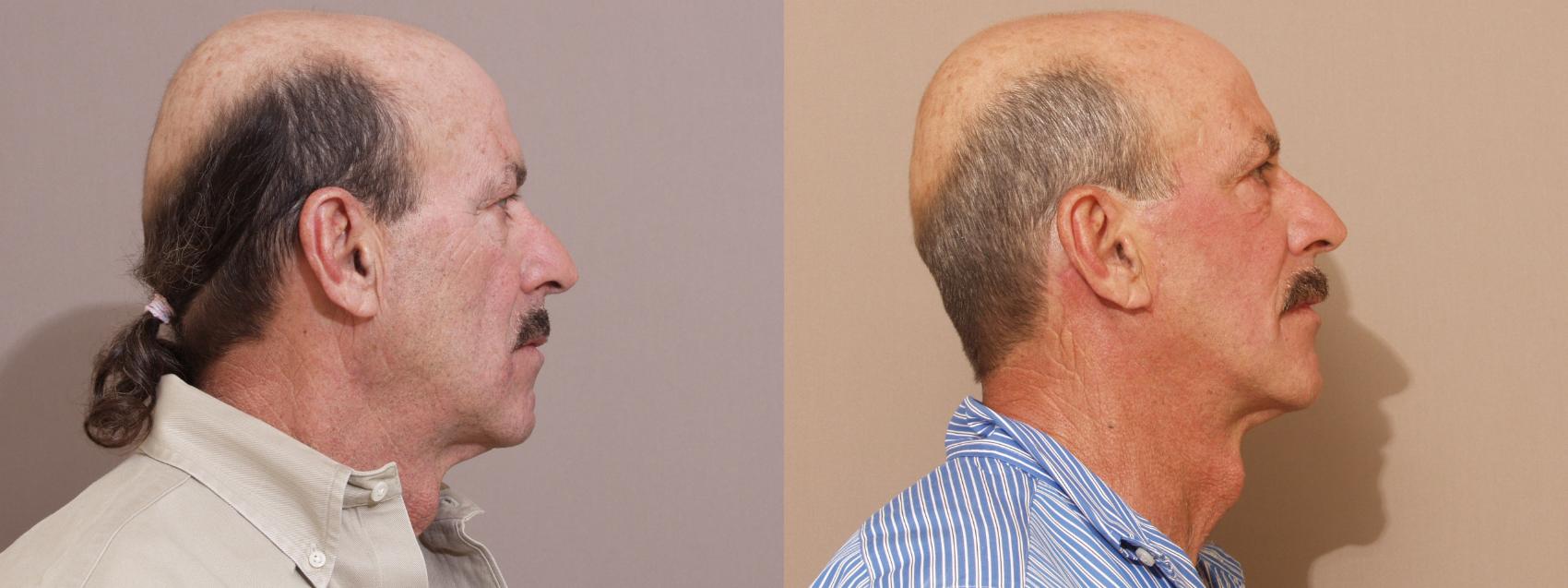 Facelift Case 81 Before & After View #2 | Webster, TX | Houston Plastic and Reconstructive Surgery