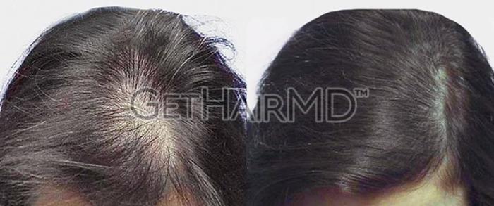 GetHairMD Hair Restoration Case 303 Before & After Top | Webster, TX | Houston Plastic and Reconstructive Surgery
