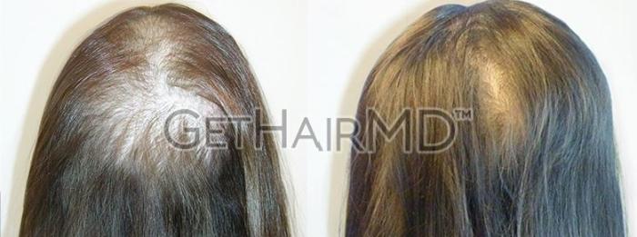 GetHairMD Hair Restoration Case 304 Before & After Top | Webster, TX | Houston Plastic and Reconstructive Surgery