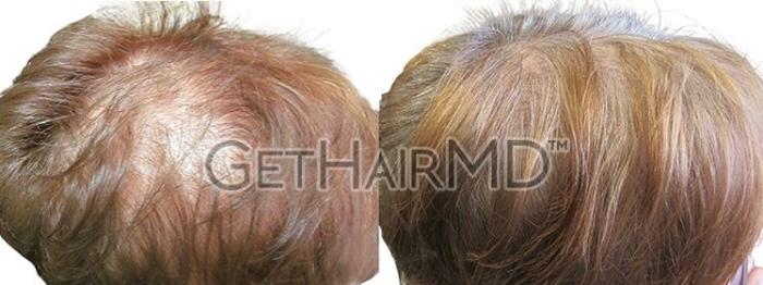 GetHairMD Hair Restoration Case 305 Before & After t | Webster, TX | Houston Plastic and Reconstructive Surgery