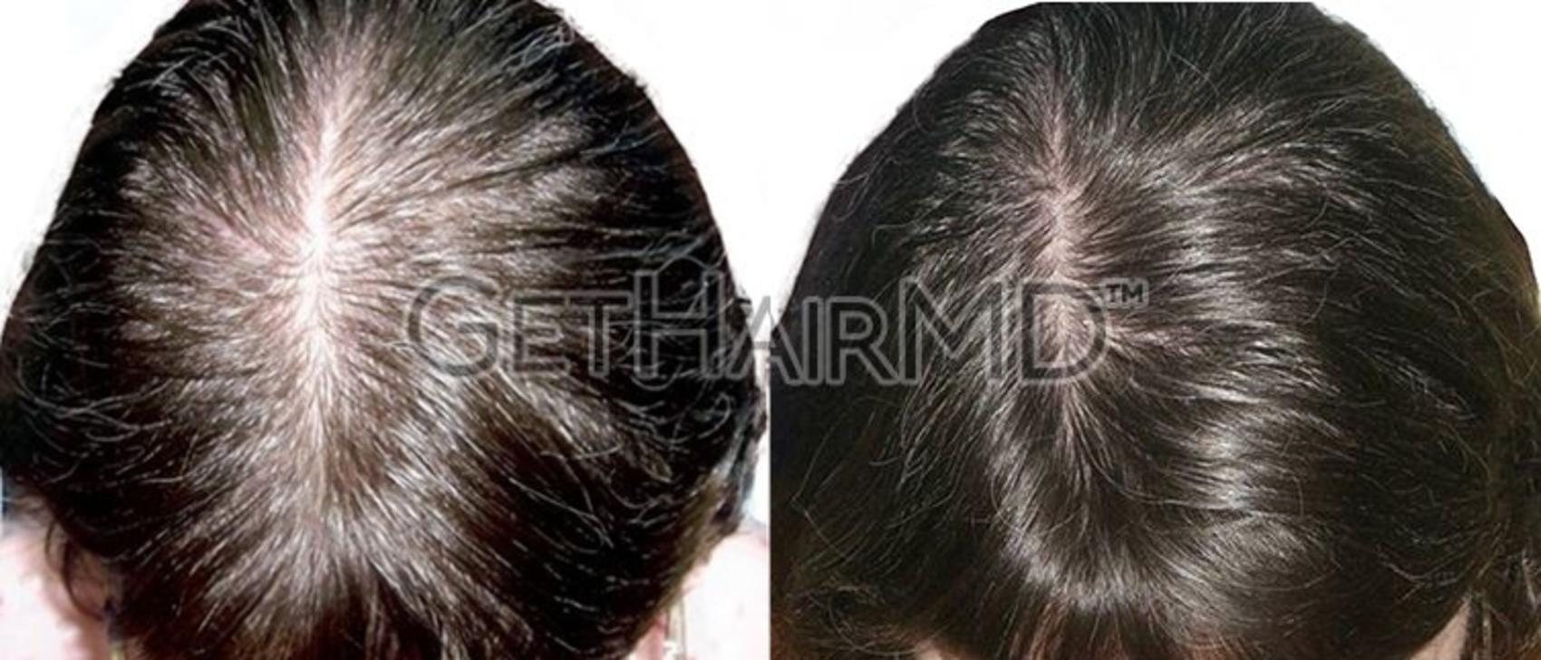 GetHairMD Hair Restoration Case 306 Before & After t | Webster, TX | Houston Plastic and Reconstructive Surgery